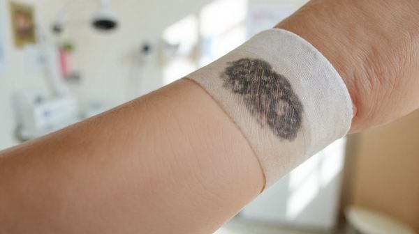 Guide ultime pour effacer un tatouage à Lyon en 2023